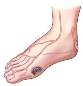 Chronic Wound Healing With Stem Cells