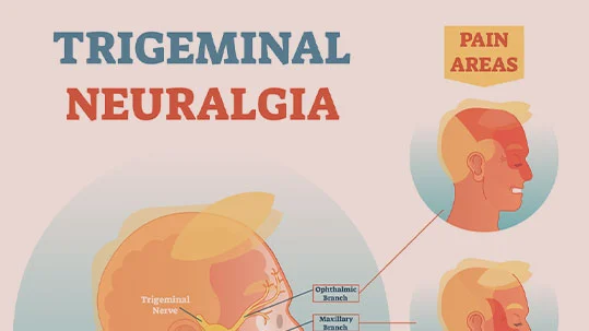 Anatomical illustration showing trigeminal nerve branches and pain regions in trigeminal neuralgia